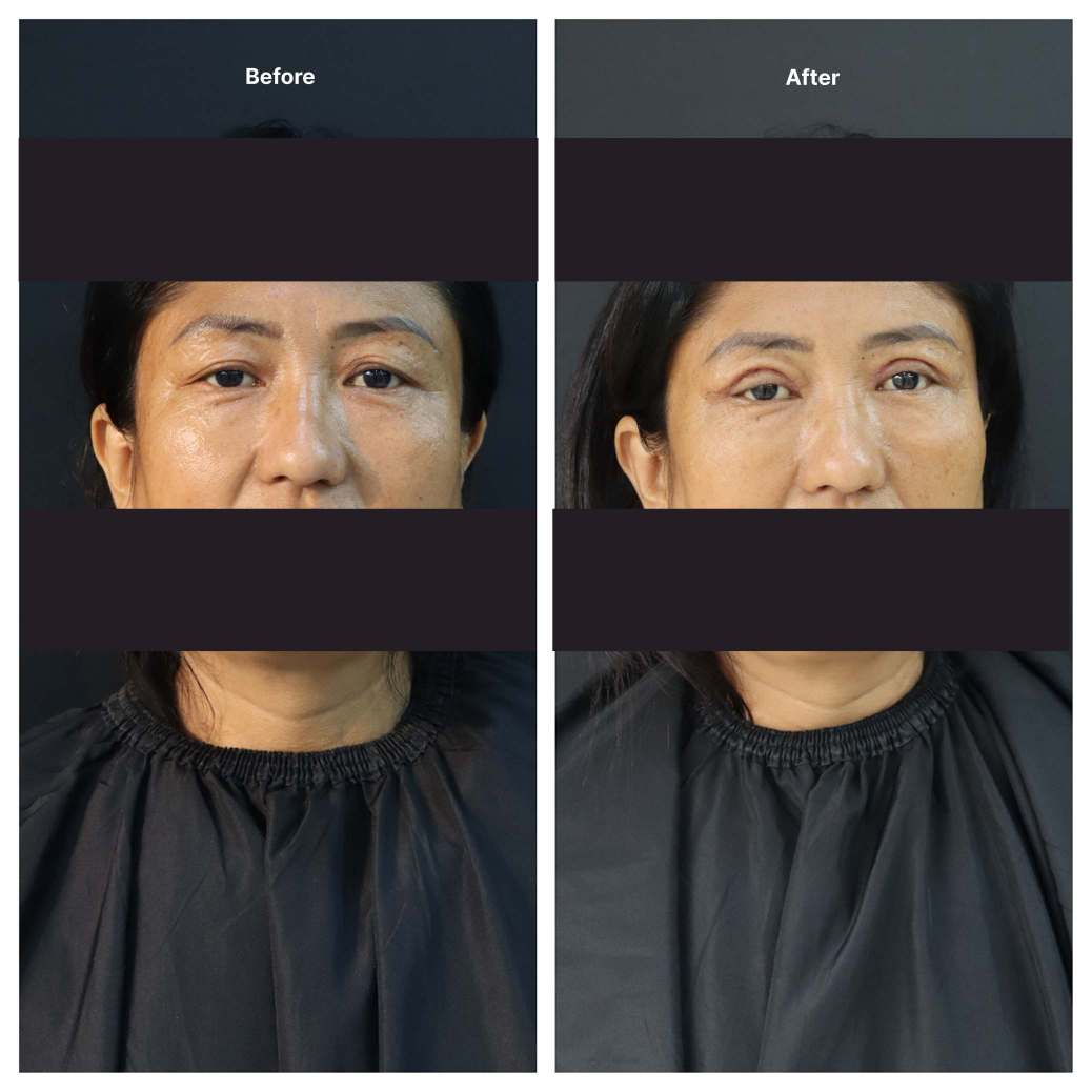 Eyelid Surgery KOQ10